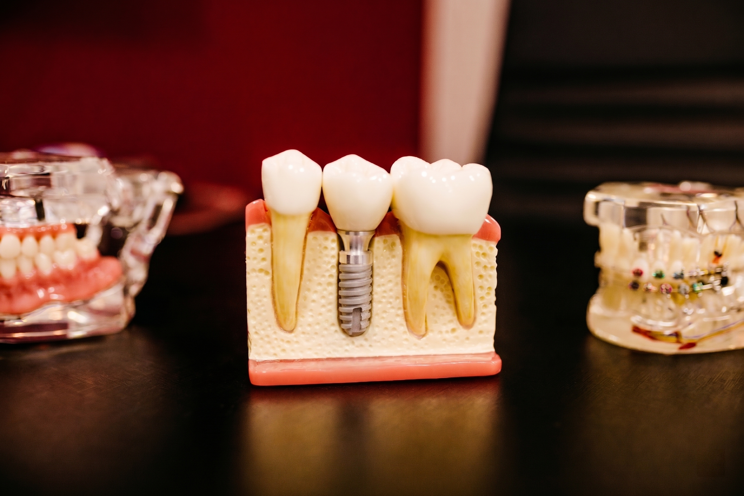 Dental implant cross-section model showing titanium implant screw placed in jawbone alongside natural teeth
